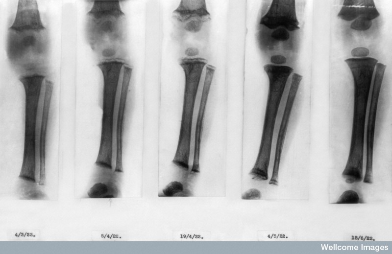 X-rays showing the healing effects of cod liver oil and sunlight on the lower leg bones of a child with rickets. Credit: Wellcome Library, London