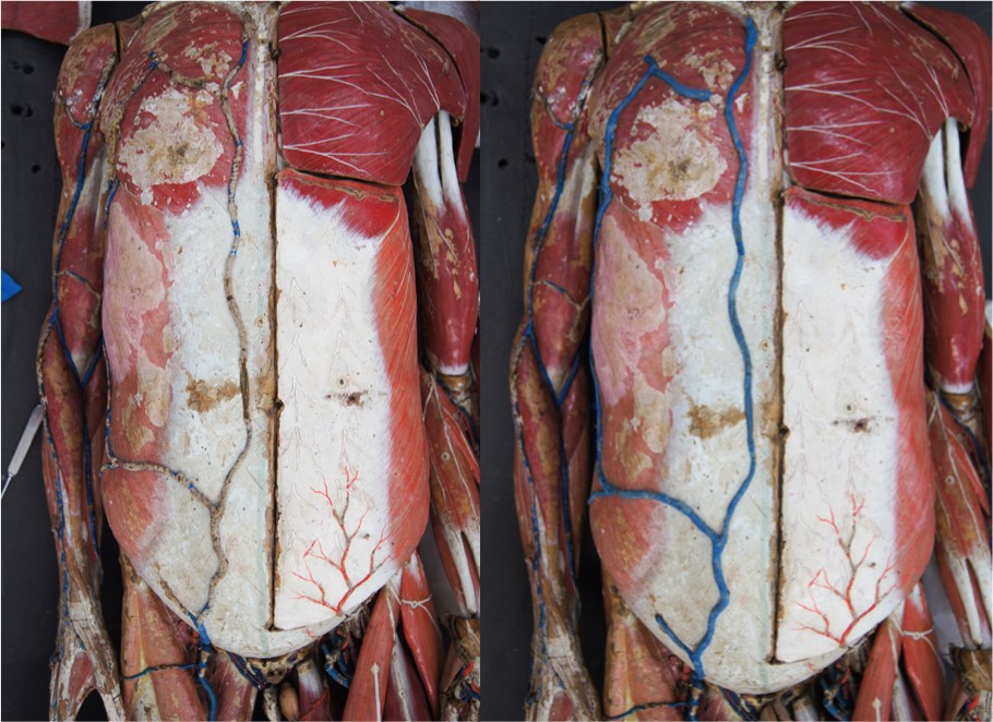Before and after treatment on the veins in the torso
