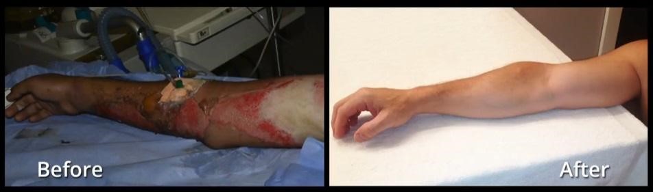 arm healed without scarring thanks to SkinGun