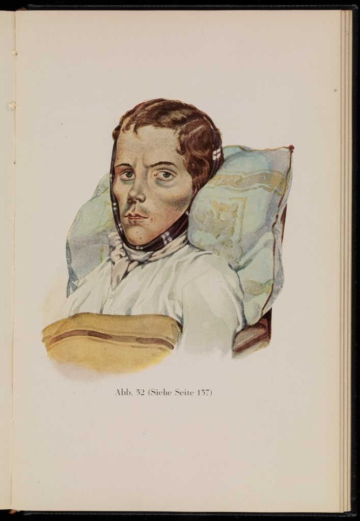 Man suffering from pulmonary tuberculosis. Illustration from Kranken-Physiognomik / by von K. H. Baumgärtner / 1929. Credit: Wellcome Collection 
