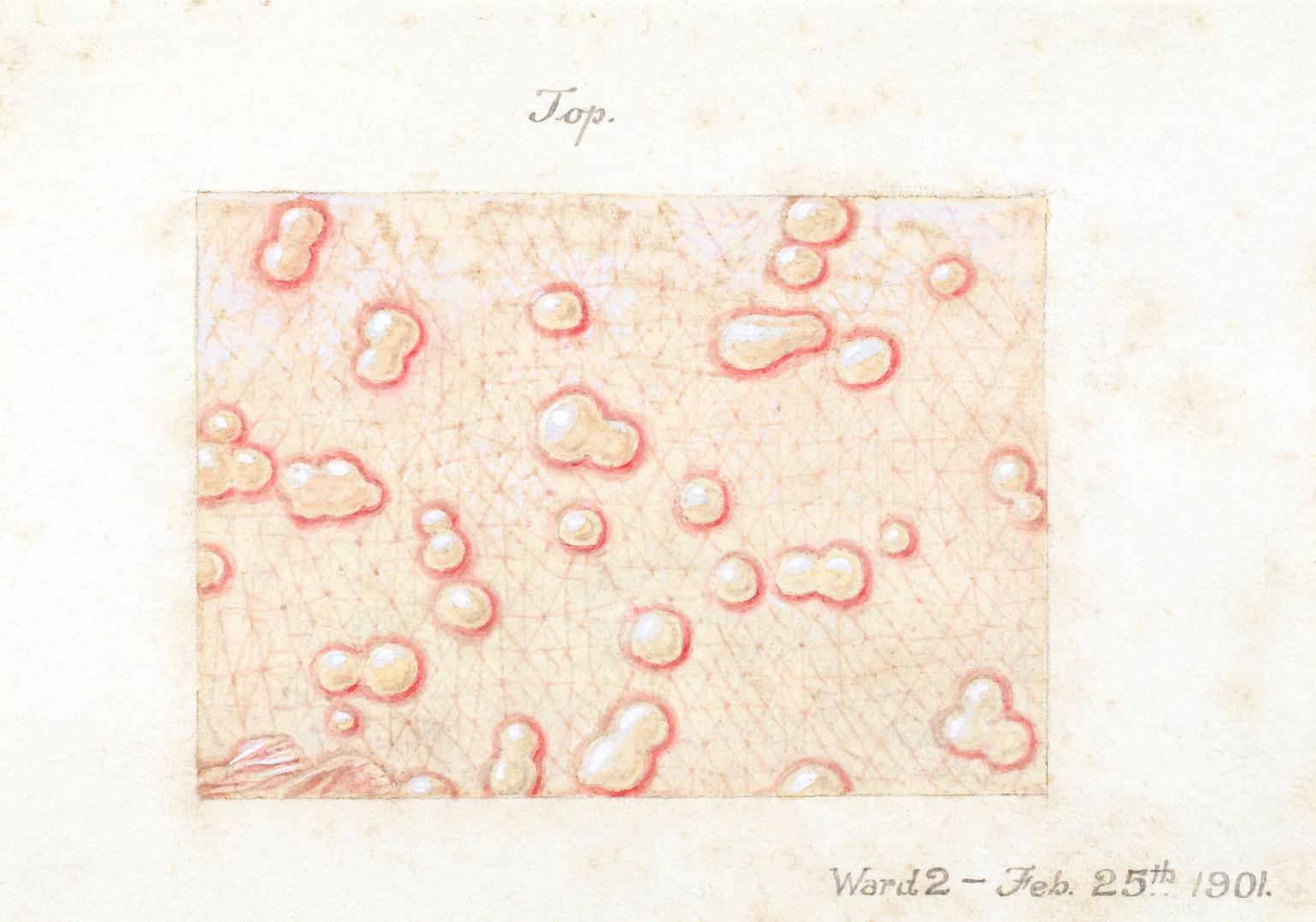 Watercolour illustration of a skin disease